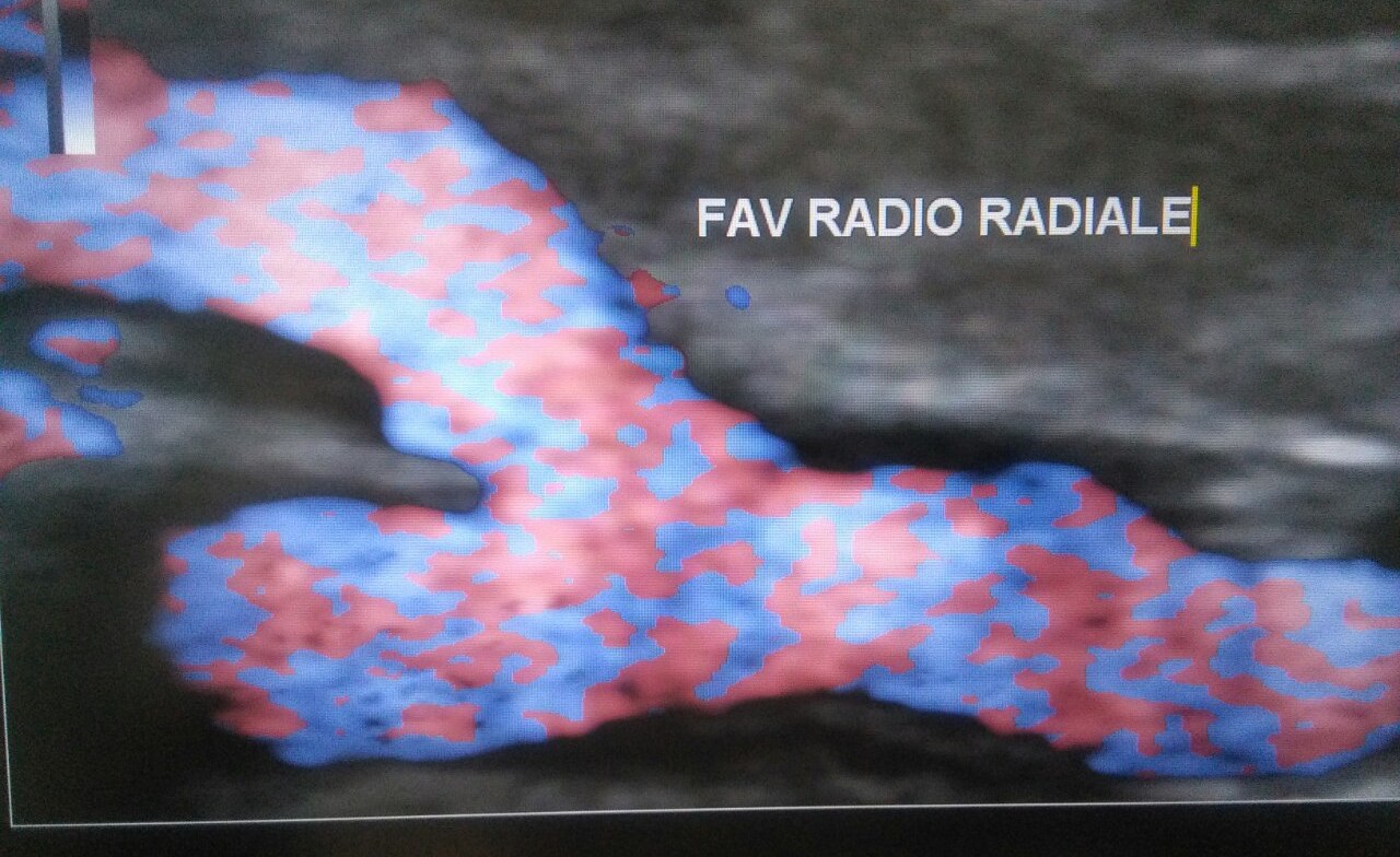 Echo-doppler des fistules artério-veineuses